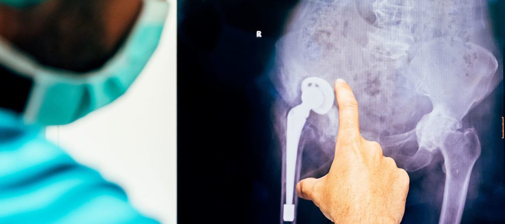 Metal-On-Metal Hip Implants & Metallosis