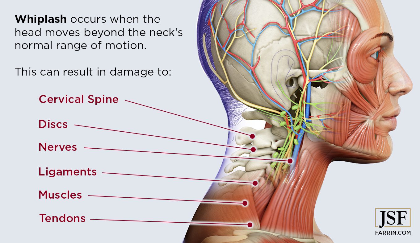 Whiplash can cause damage to the spine, discs, muscles, nerves, tendons, and ligaments in the neck.
