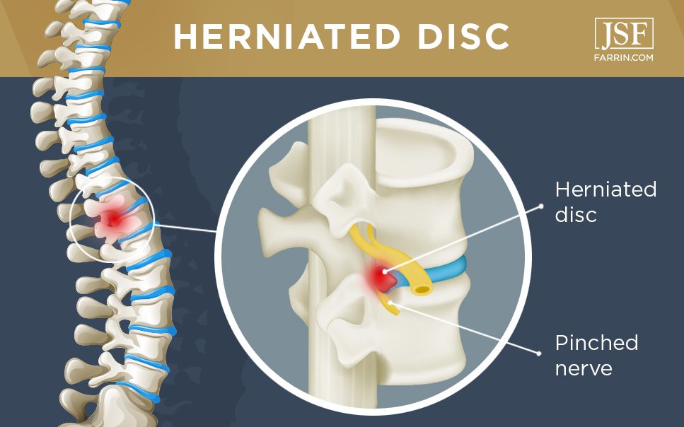 Herniated Disc, Bangor, Ellsworth