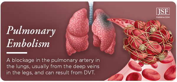 Pulmonary embolism: when a blood clot travels to the lungs. It can be caused by DVT.