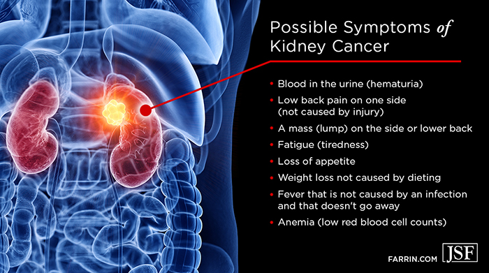 Symptoms of kidney cancer can include back pain, weight loss, fever, anemia & blood in urine.