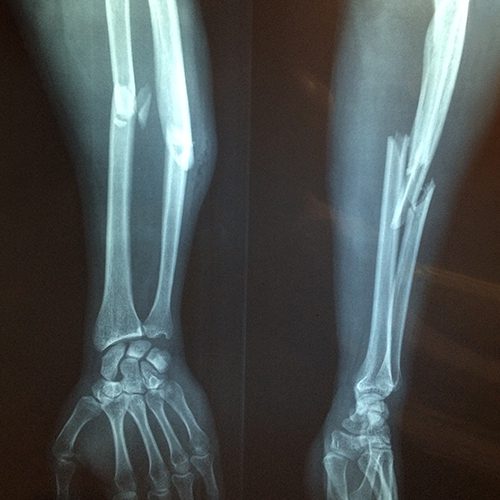 Radiograph of an arm with the radius and ulna bones fractured.