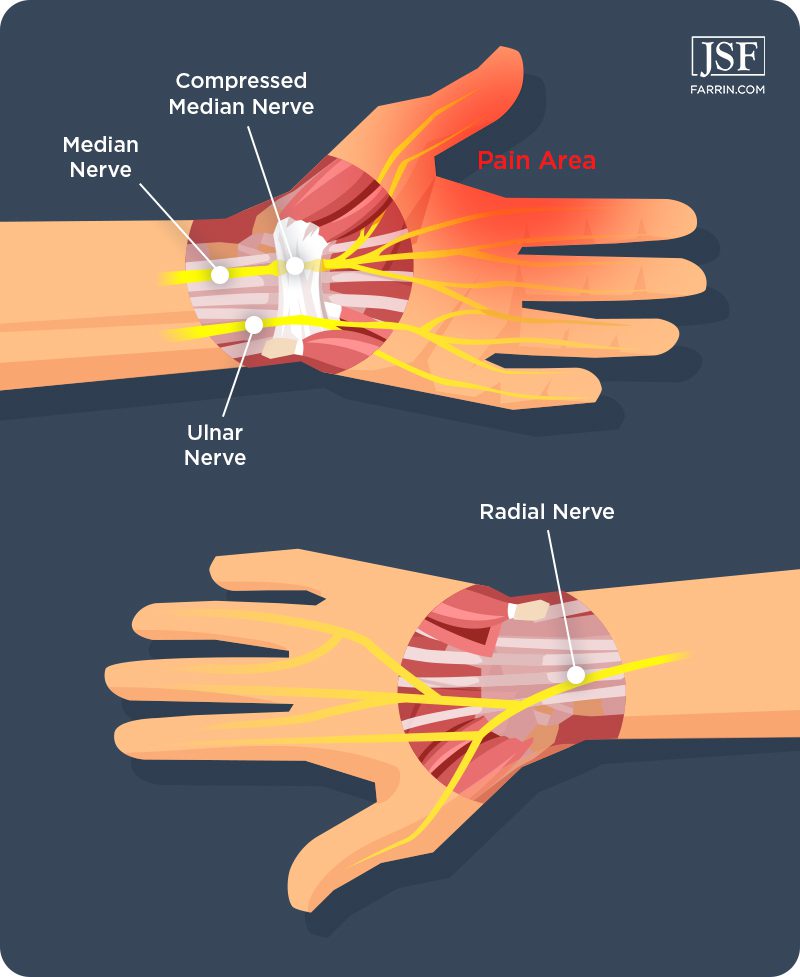 A compressed median nerve in the wrist/metacarpal area of the hand can be a source of pain.
