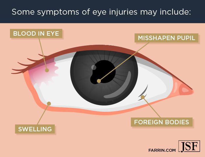 Symptoms of eye injuries may include blood in the eye, misshapen pupils, swelling or foreign bodies in the eye.